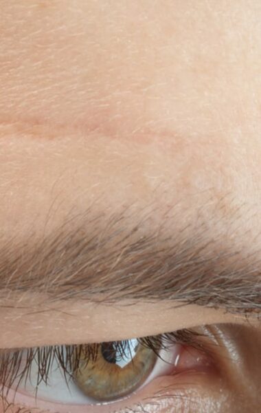 Can I remove facial scars with scar cream