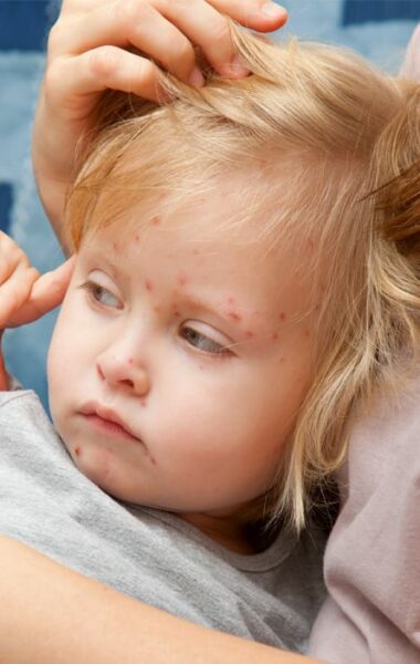 Prevent and reduce chicken pox scars