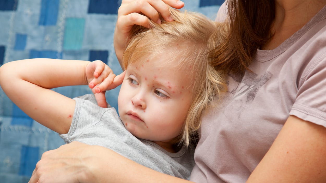 Prevent and reduce chicken pox scars - ALHYDRAN