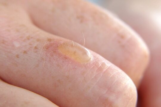 How do you treat a burn blister