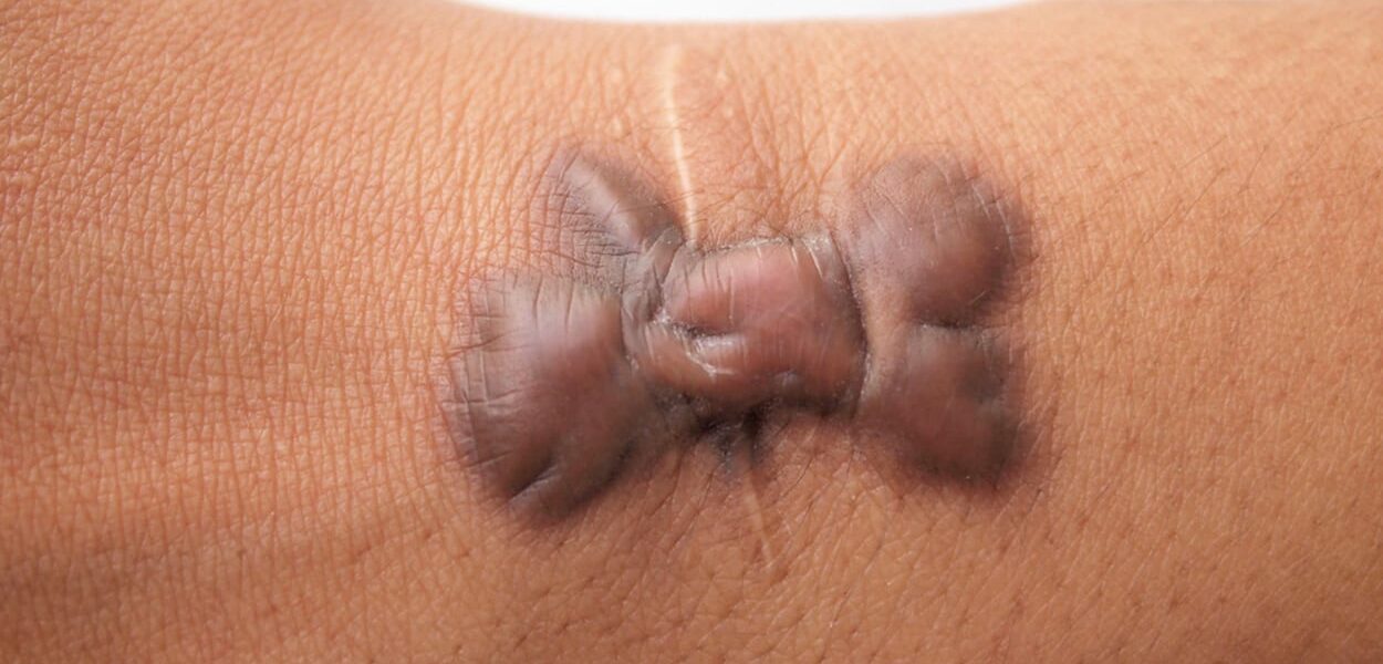 Keloid scar treatment