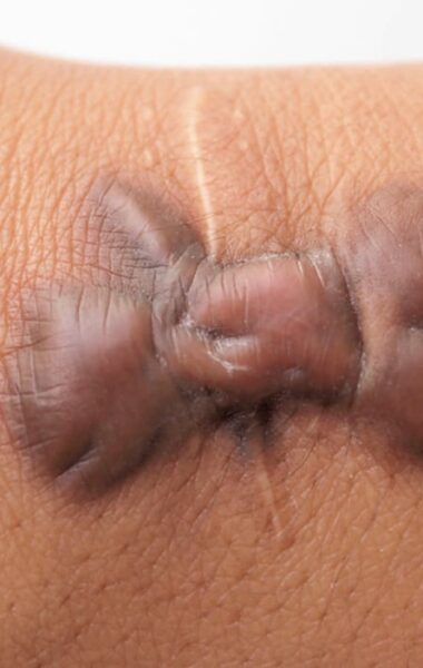 Keloid scar treatment