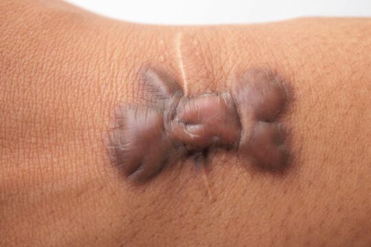 Keloid scar treatment