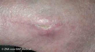 ALHYDRAN Case Study: Chronical wound - After