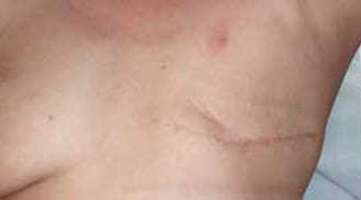 ALHYDRAN Case Study: Radiotherapy - After