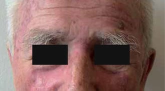 ALHYDRAN Case Study: Erosive skin - After