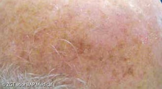 ALHYDRAN Case Study: Actinic keratosis - After