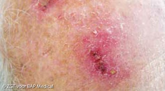 ALHYDRAN Case Study: Actinic keratosis - Before