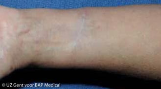 ALHYDRAN Case Study: Surgery scar - After