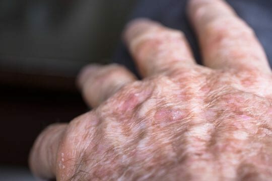 ALHYDRAN actinic keratosis after-care