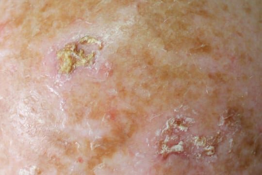 ALHYDRAN actinic keratosis after-care