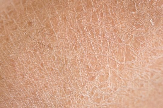 ALHYDRAN dry skin treatment