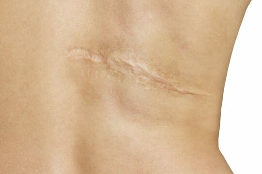 ALHYDRAN scar treatment