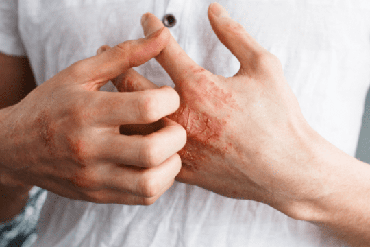 eczema