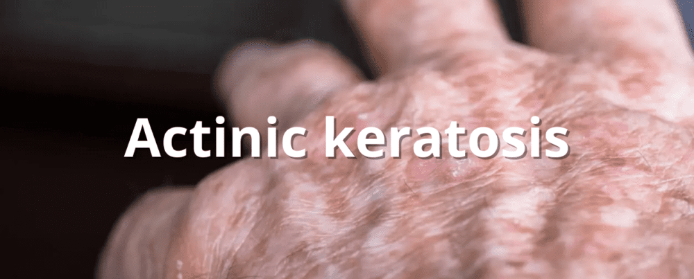actinic keratosis