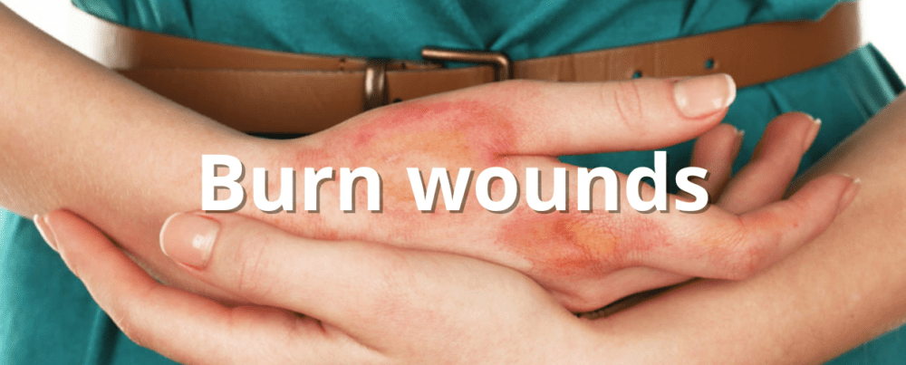 burn wounds