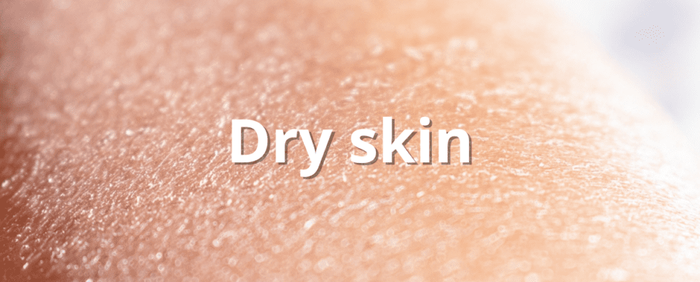 dry skin