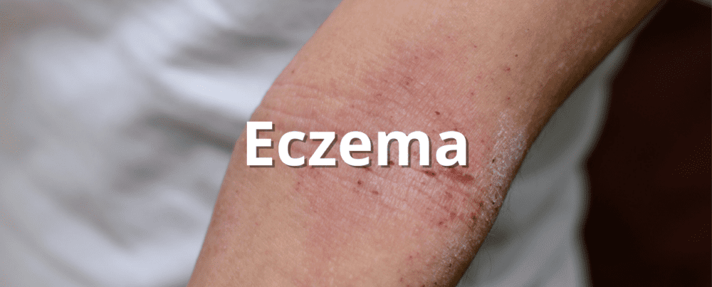 eczema