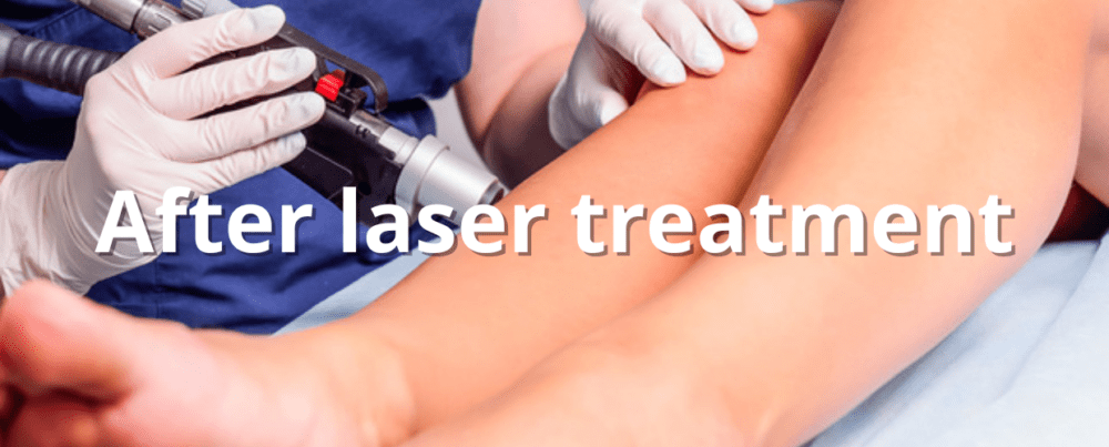 laser treatment
