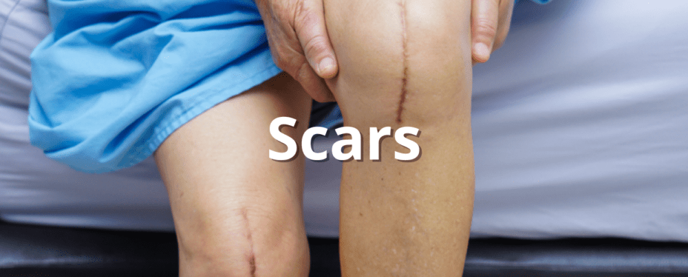 scars