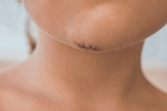 wound scar